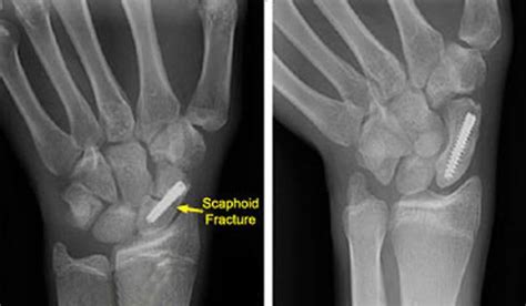 scaphoid fracture prognosis